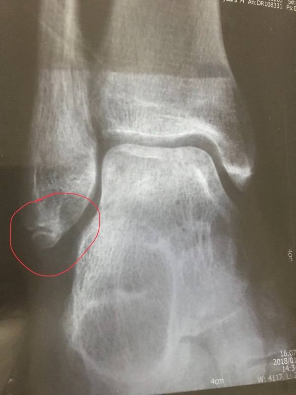 腓骨骨折需要手术吗 胫腓骨骨折 腓骨骨折需要手术吗 胫腓骨骨折