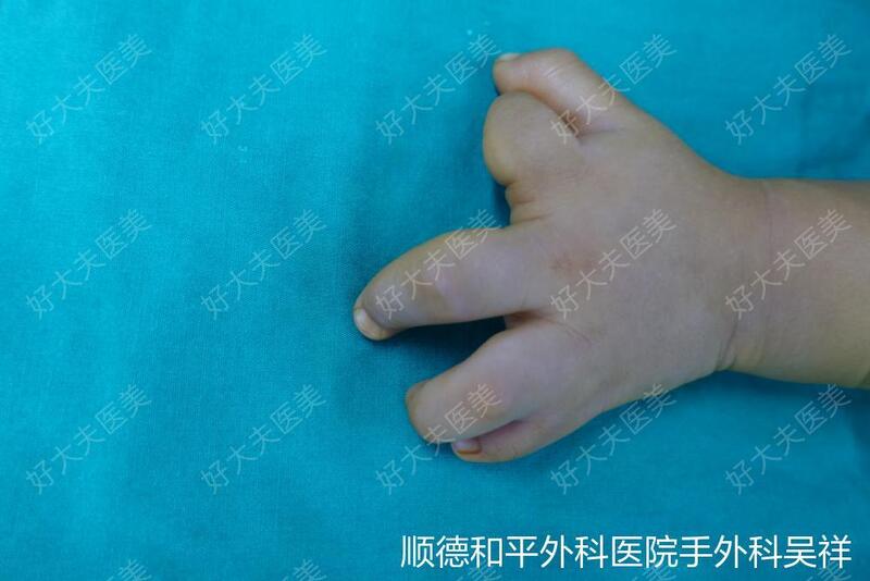 诊断:1,左环,小指先天性并指畸形2,左示指先天性桡偏畸形术式:左环