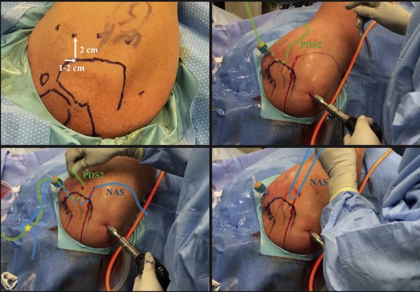 savoie2019年一种单钉两线缝合法治疗肩袖损伤关节侧撕裂的手术技术