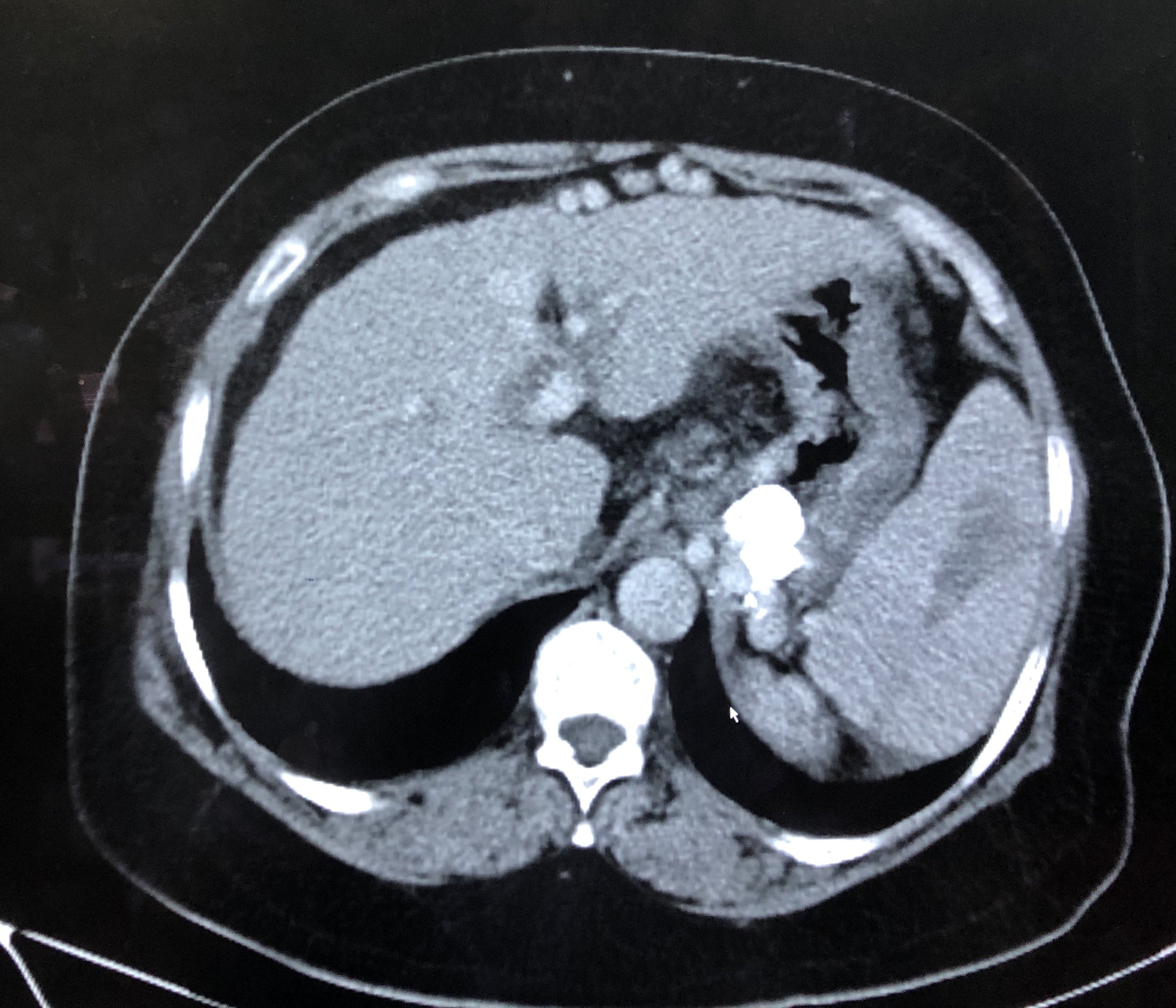 脾栓塞加脾消融治疗门脉高压消化道出血案例分享 - 好大夫在线