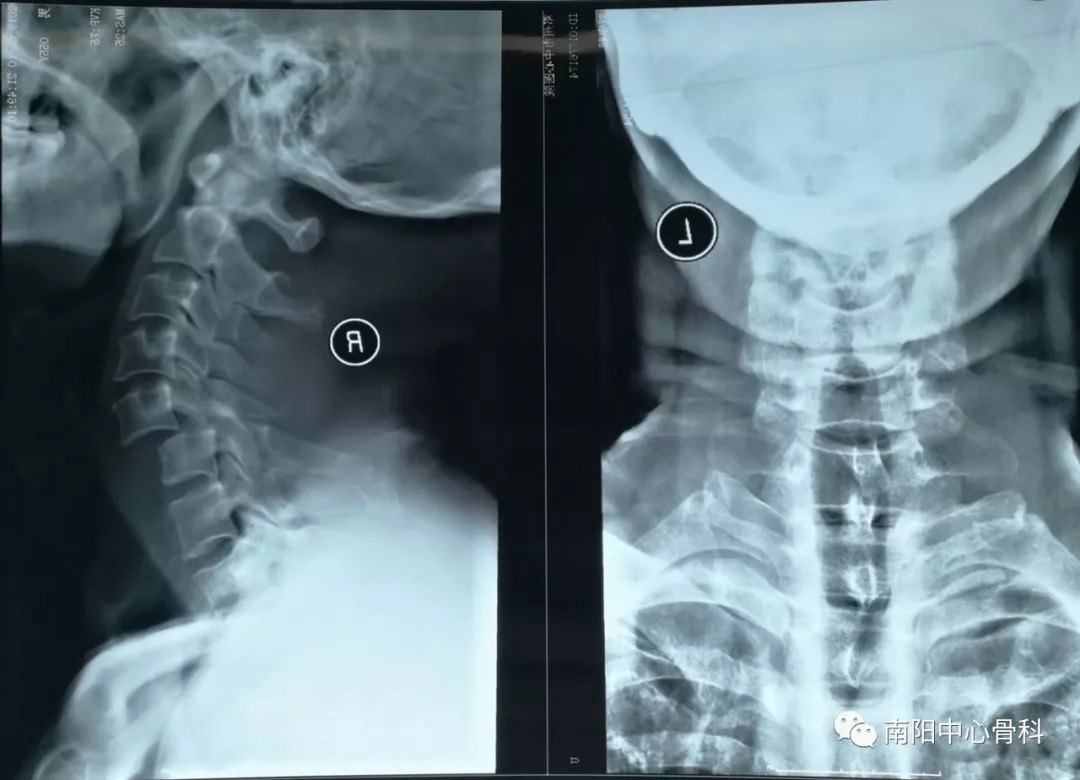 一例严重颈椎骨折脱位的手术治疗