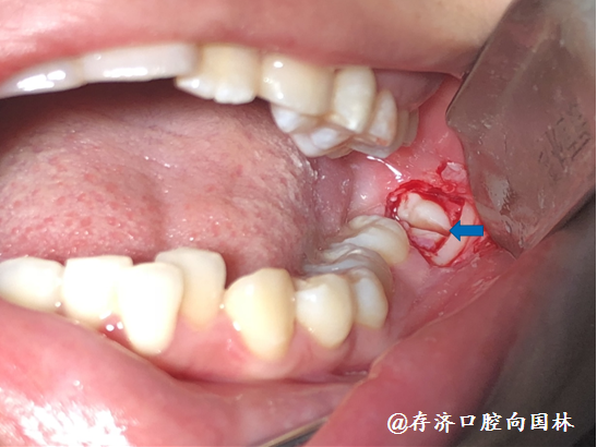 超声骨刀拔智齿图解图片
