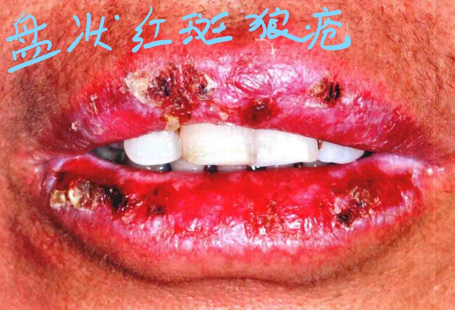 口腔黏膜——罕见角化型白色病变的图文介绍 