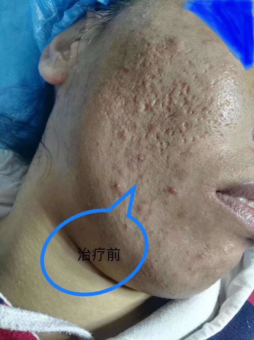 超脉冲二氧化碳点阵激光_激光美容_激光美容治疗介绍 - 好大夫在线