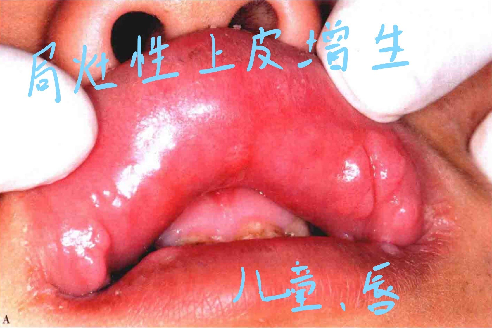 口腔颊粘膜增生图片