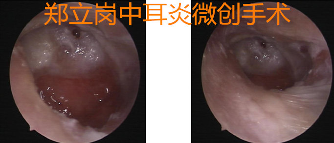 三十年膽脂瘤中耳炎小切口微創三小時治癒