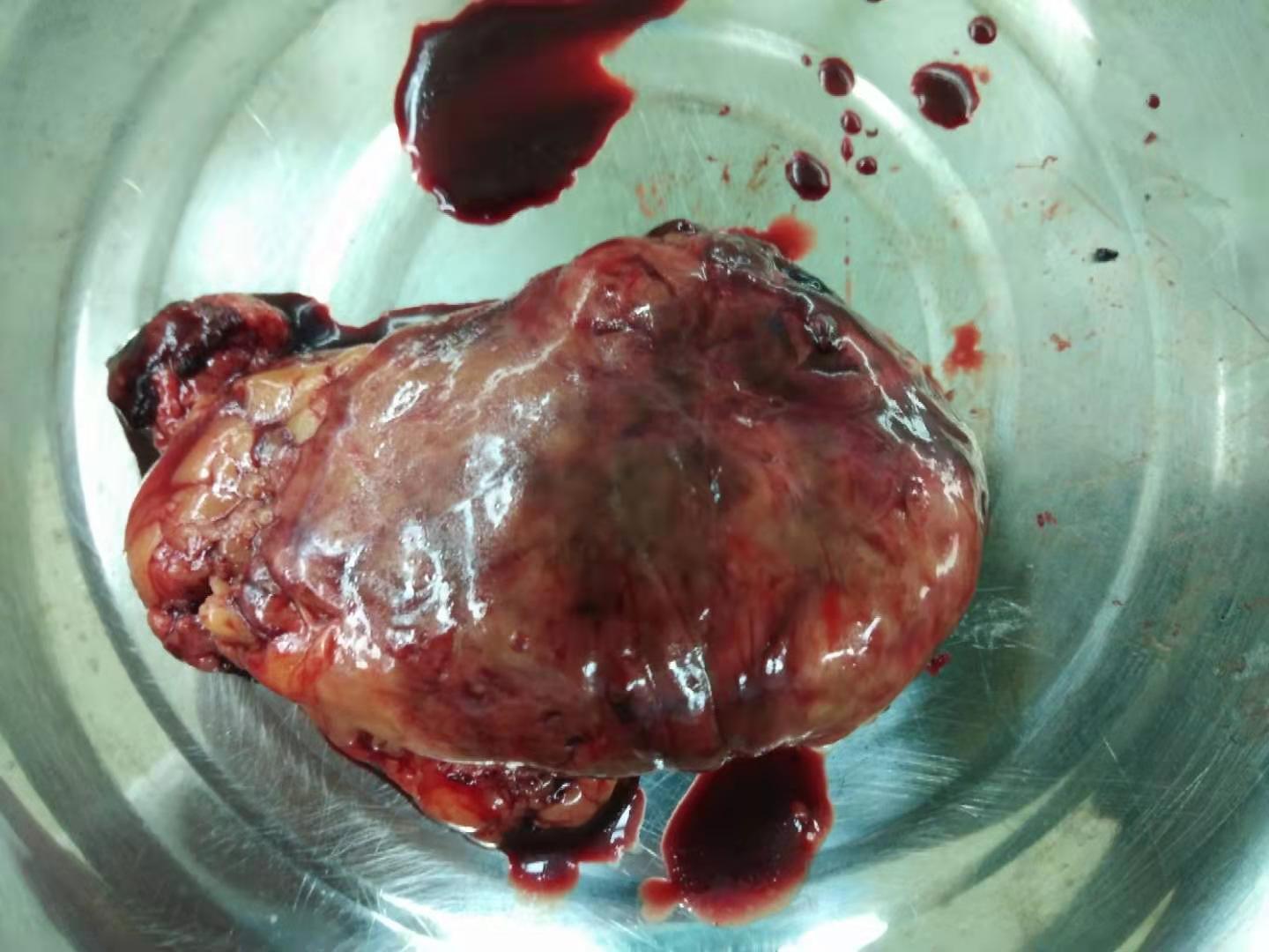 采用腹腔镜完整保肾治疗肾错构瘤破裂伴肾周血肿