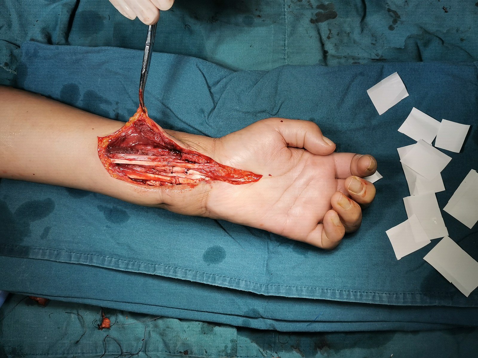 经验分享:如何处理腕部切割伤 