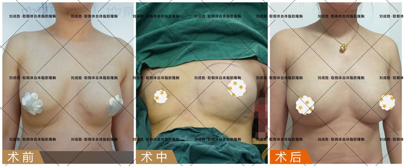 乳房假体取出 做完假体隆胸后多久取出假体 隆胸假体一定要取出吗 隆胸