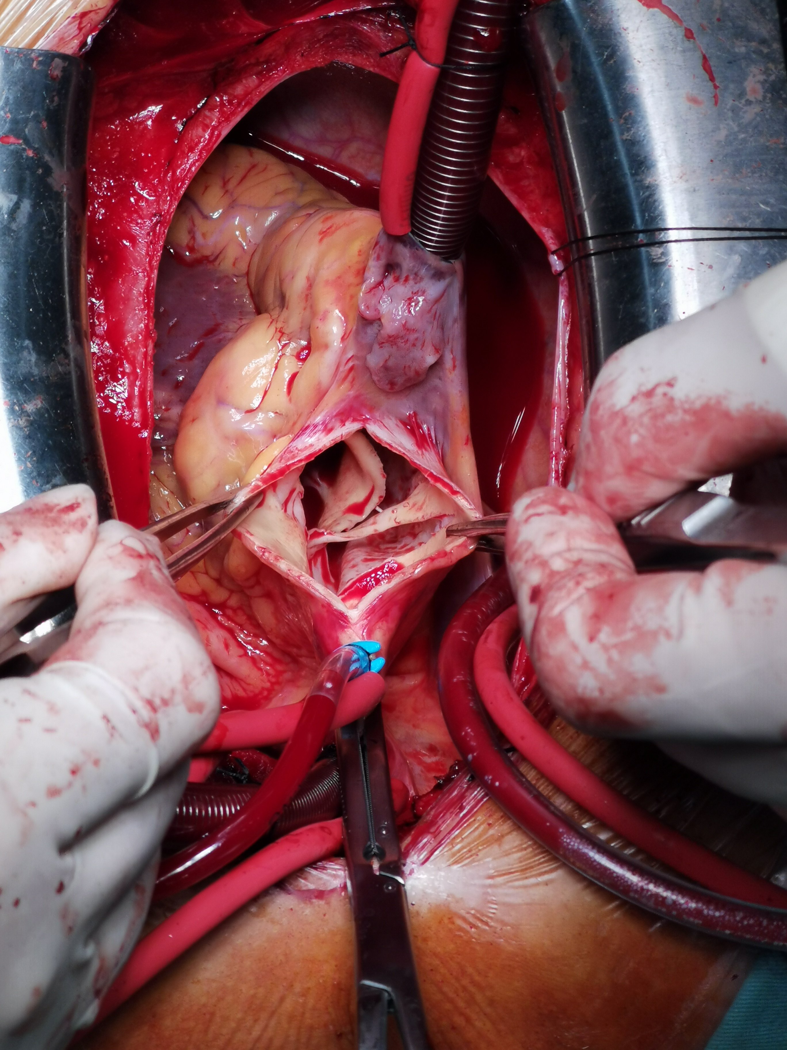 主动脉夹层手术步骤图图片