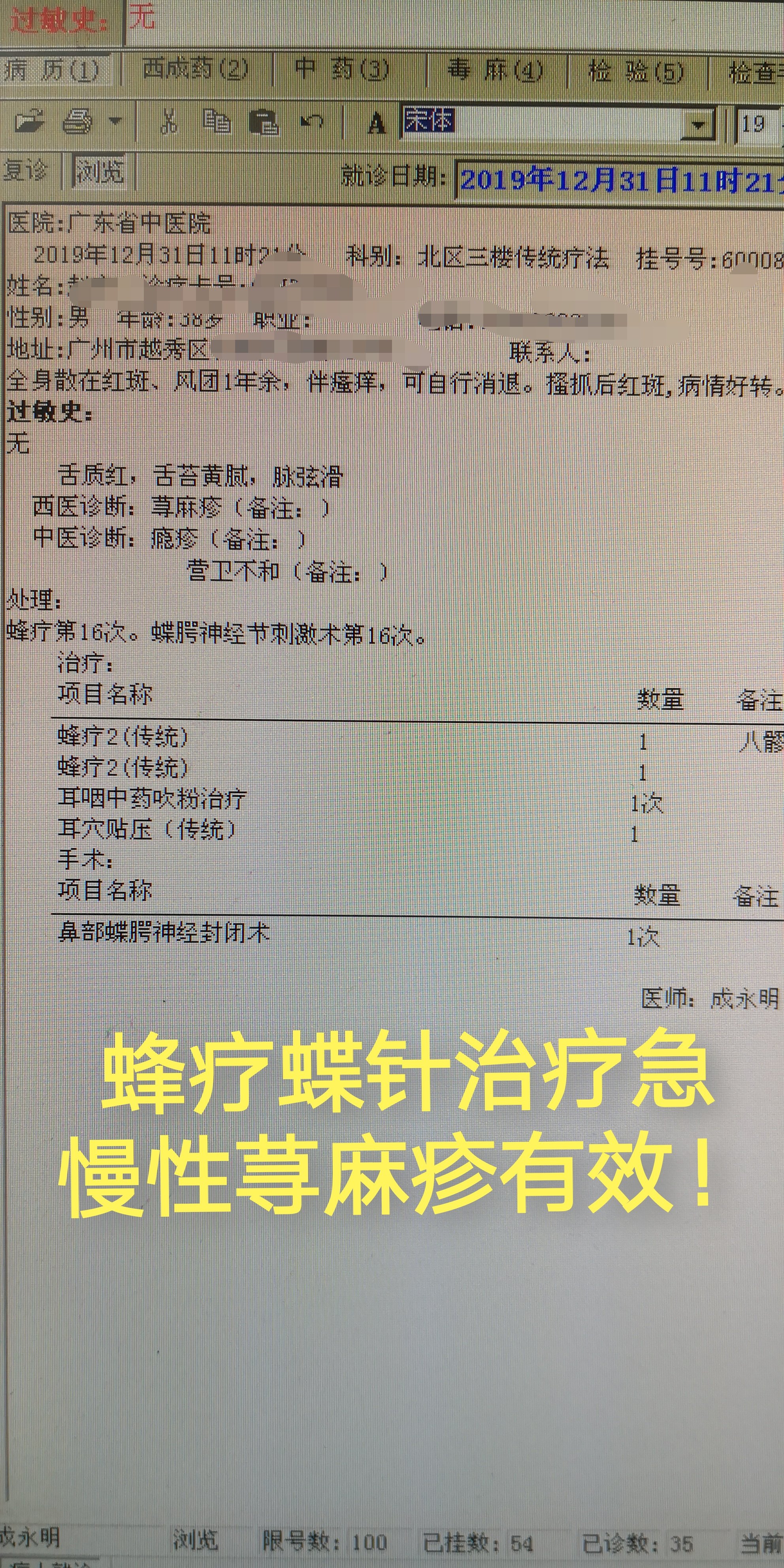 慢性蕁麻疹風團用蜂療蝶顎神經節刺激術療效顯著