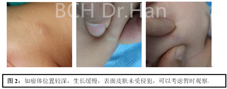 儿童钙化上皮瘤毛母质瘤手术时机及治疗方案的选择