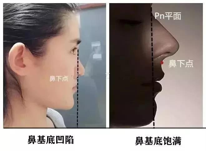 拿什么拯救你的大饼脸和月亮脸 鼻基底 鼻部整形