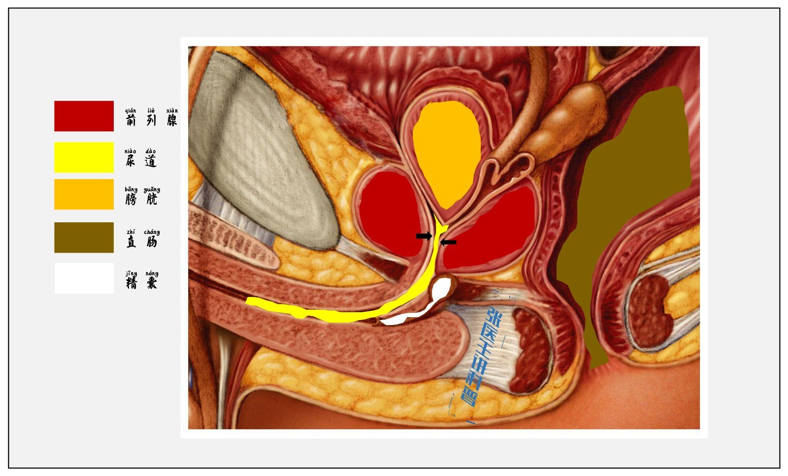 前列腺增生示意图图片