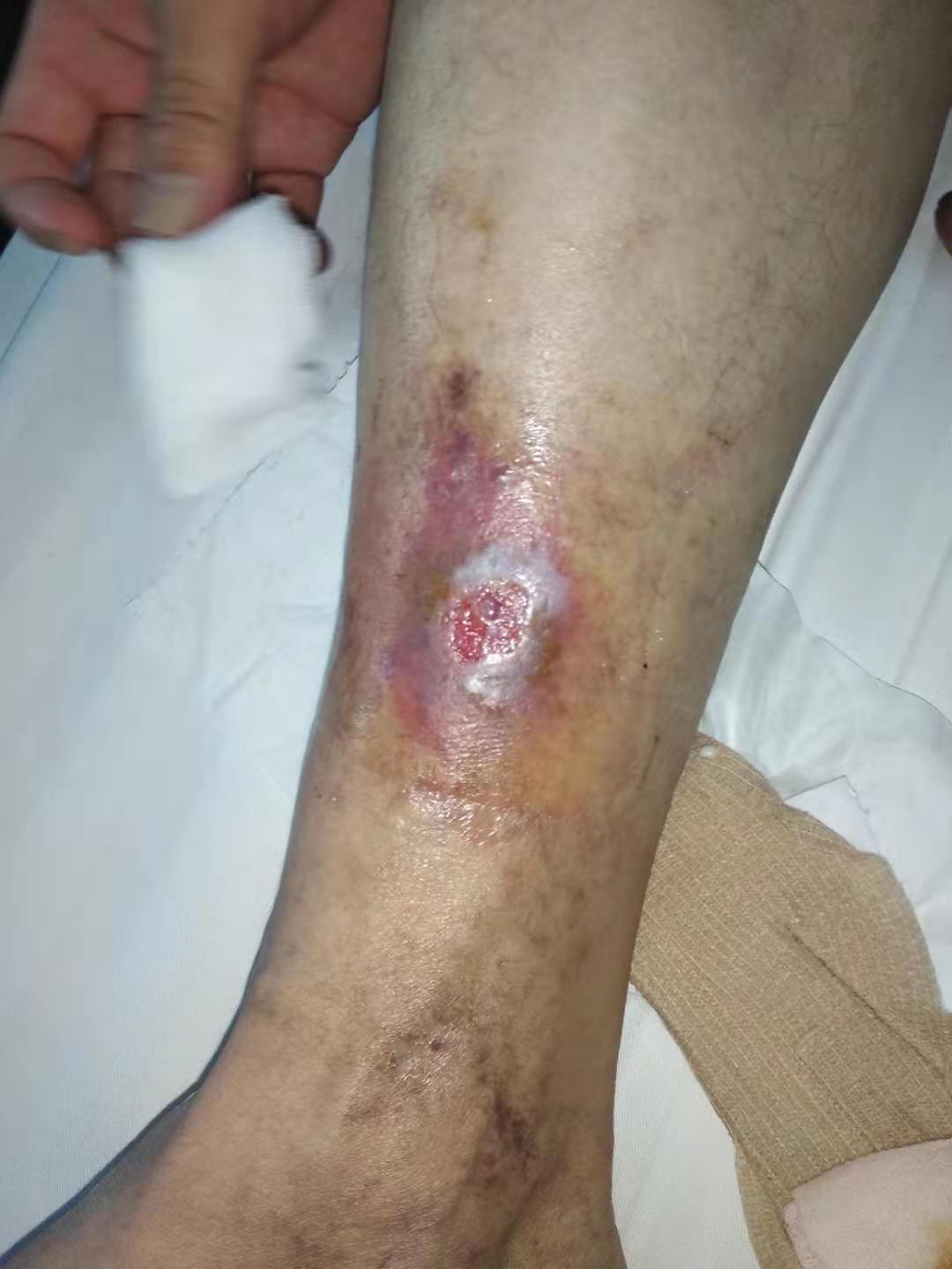 老烂腿好发于哪些部位