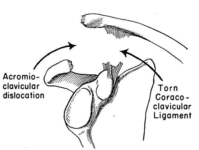 8 肩锁关节脱位 韧带韧带断裂.jpg