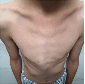 鸡胸微创手术治疗系列-9 - 好大夫在线