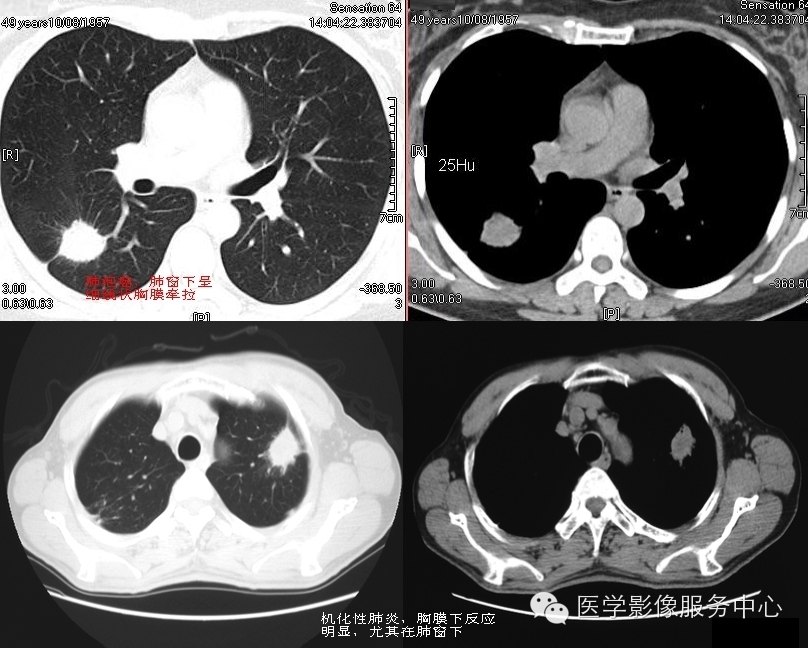 胸膜增厚超声图像图片