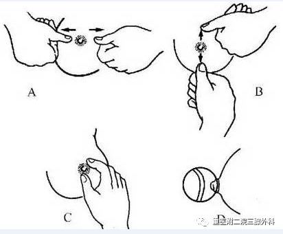 双环法乳房悬吊术图片