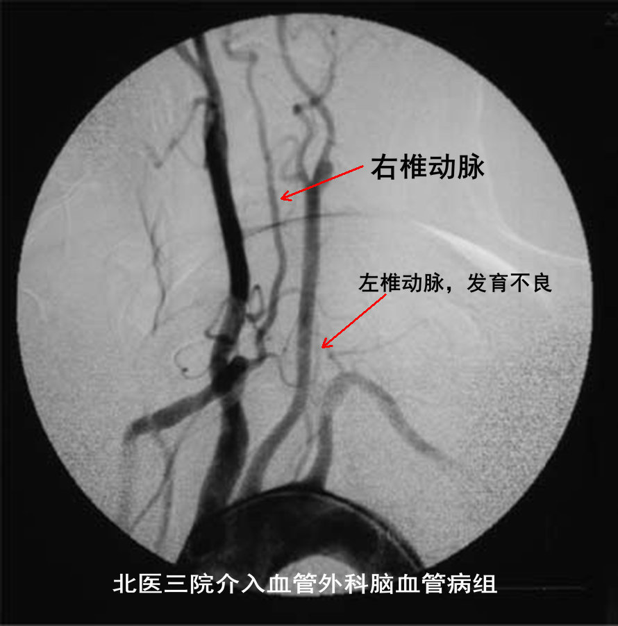 椎动脉狭窄