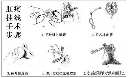 肛周脓肿怎么治最好图片