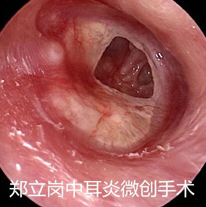 对于许多慢性化脓性中耳炎的患者来说,如果看过医生或者做过耳内镜