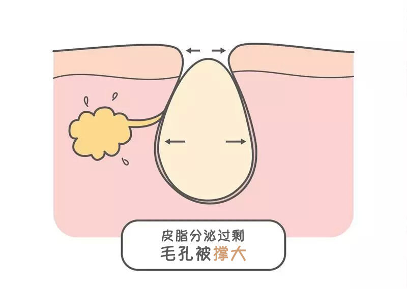 毛孔粗大|皮肤科医生有什么缩毛孔的办法?