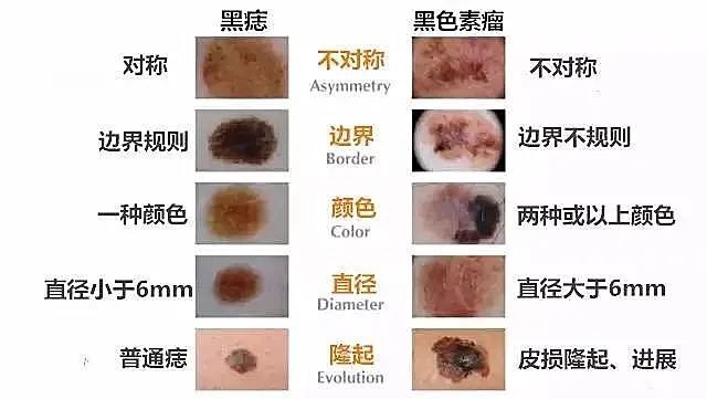 去鸡皮肤色素痣(皮肤色素痣怎么去除) 去鸡皮肤色素痣(皮肤色素痣怎么去除)