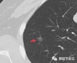 怎么看是不是纯磨玻璃结节 zoYBAGAuhwaAbn8lAAAaEZtnIBs583.jpg?_ms_=662d