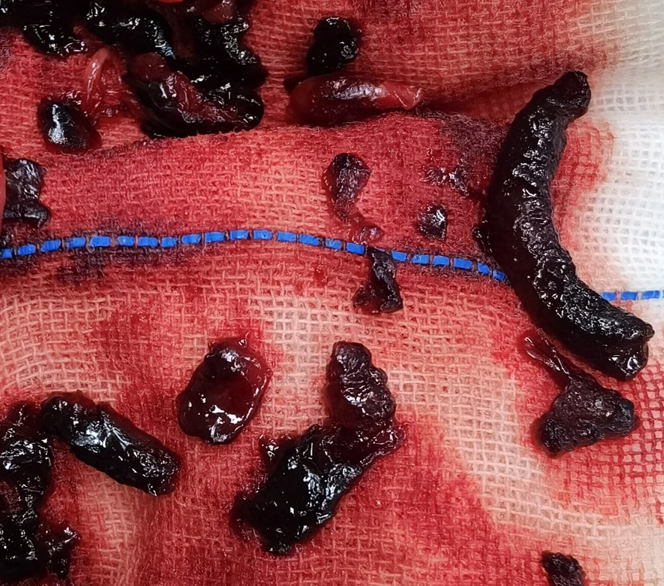 不要小觑的腿肿～深静脉血栓的致命风险