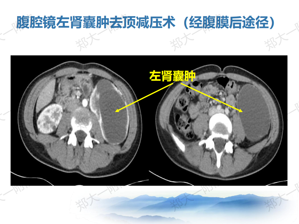 腎囊腫的診斷和治療經驗