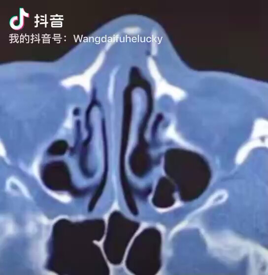 鼻骨骨折 需手术治疗 鼻骨骨折 鼻骨骨折 需手术治疗 鼻骨骨折
