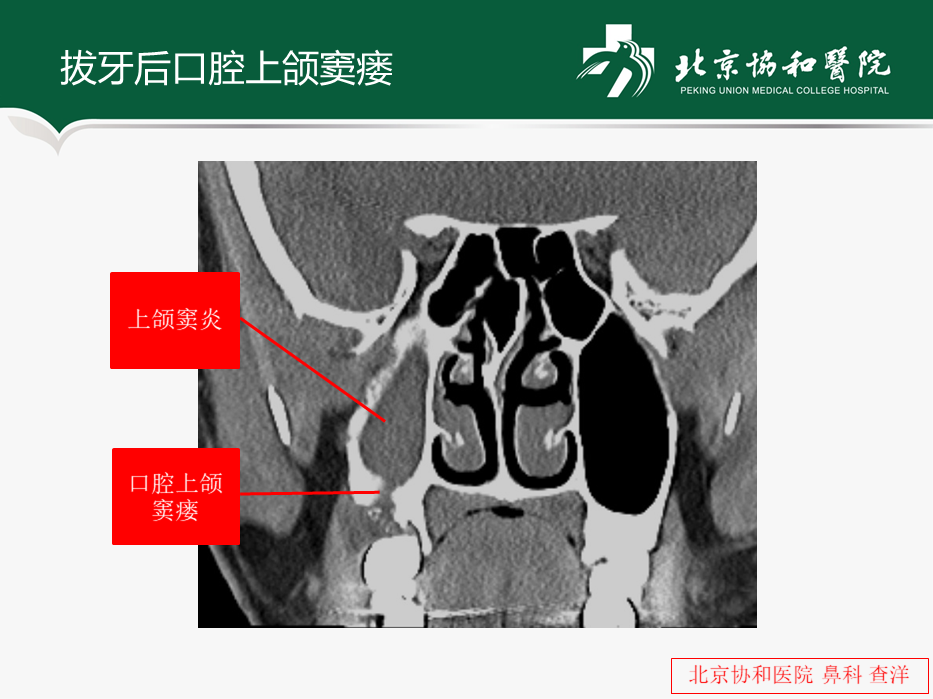 dct上的表现以上颌窦炎为主