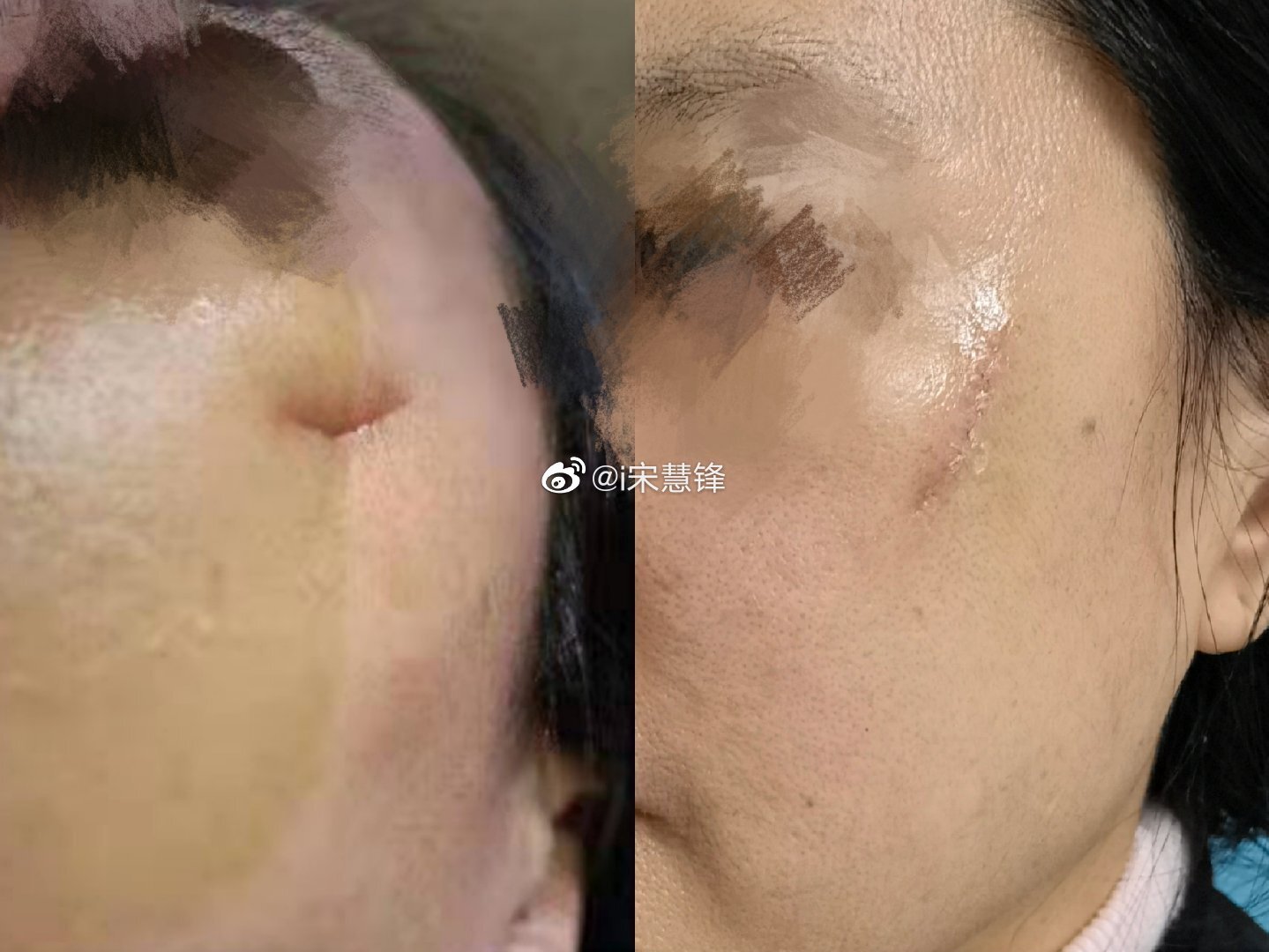 真正的整形美容缝合并没有那么简单 疤痕 疤痕 真正的整形美容缝合并没有那么简单 疤痕 疤痕