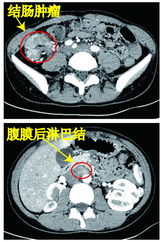 考虑结肠原发恶性肿瘤伴周围肠系膜区,腹主动脉右旁后腹膜多发淋巴结