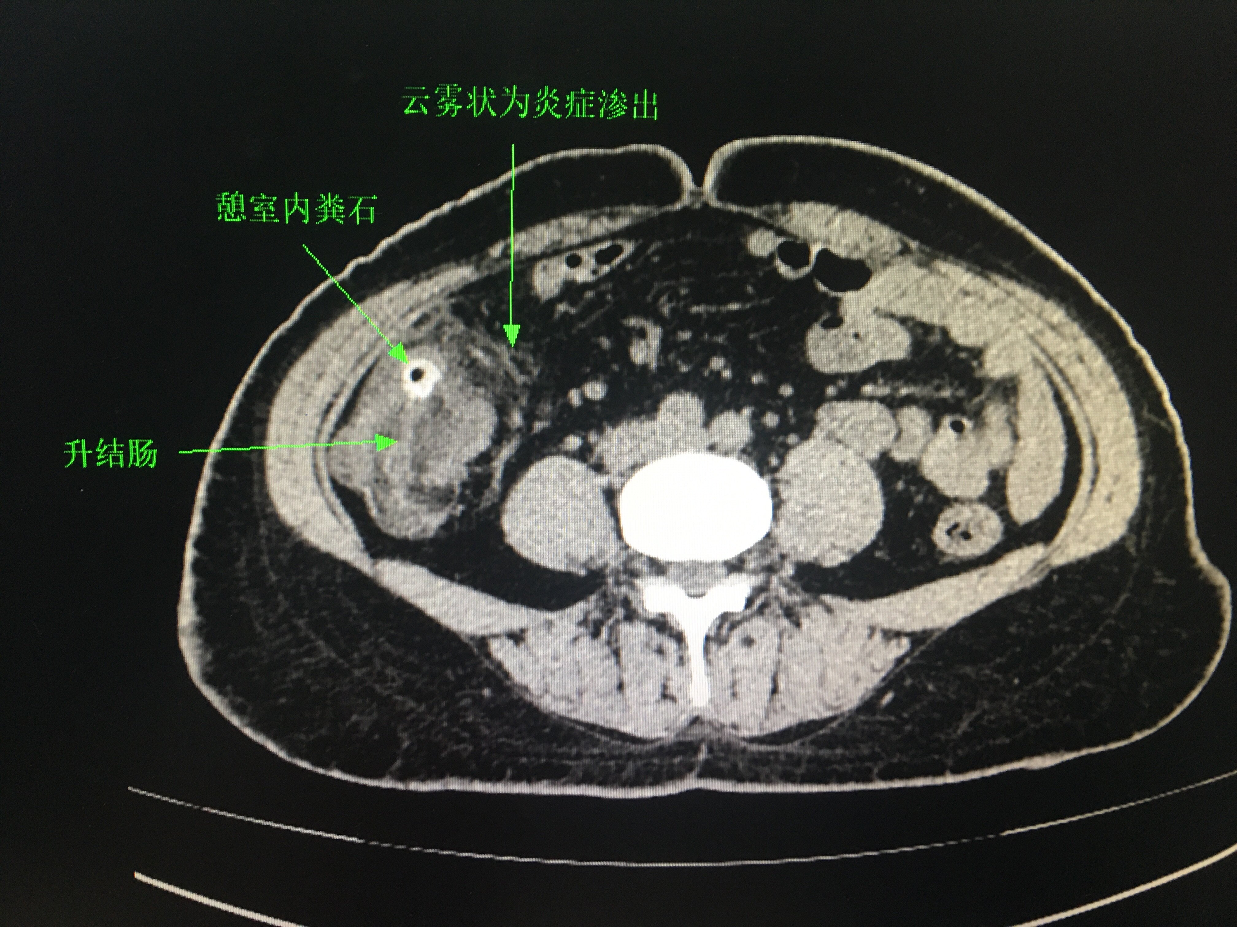 阑尾炎ct图像图片