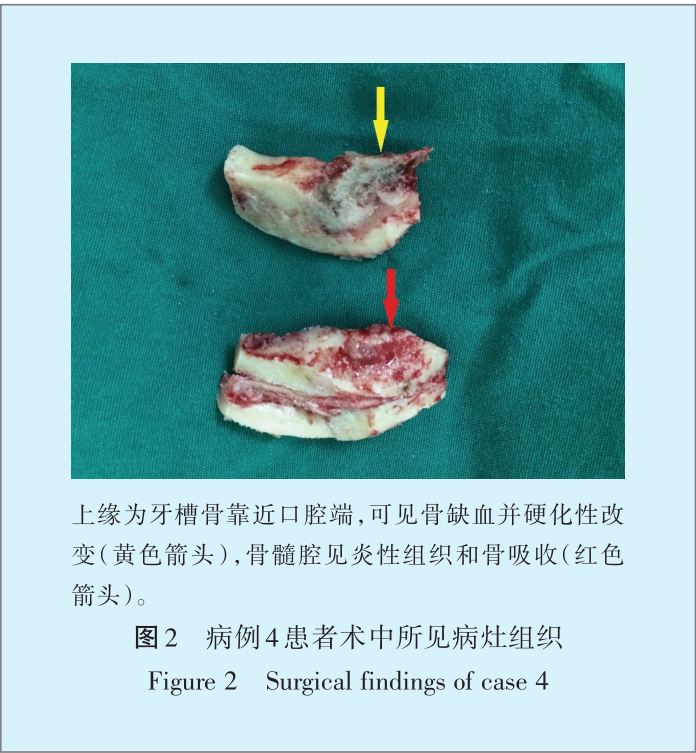 双膦酸盐类药物相关性颌骨坏死临床研究 好大夫在线
