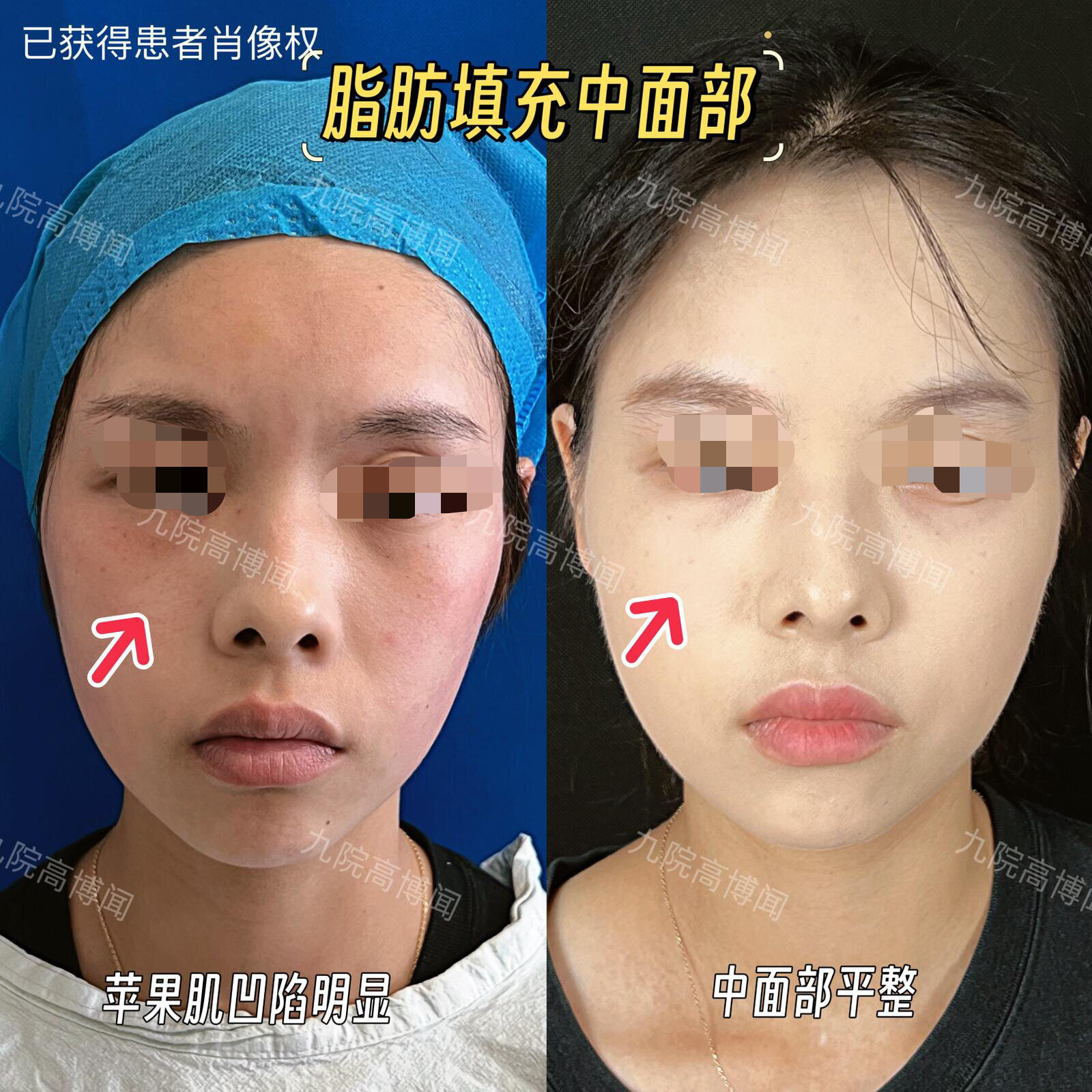 自体脂肪填充苹果肌术后一年