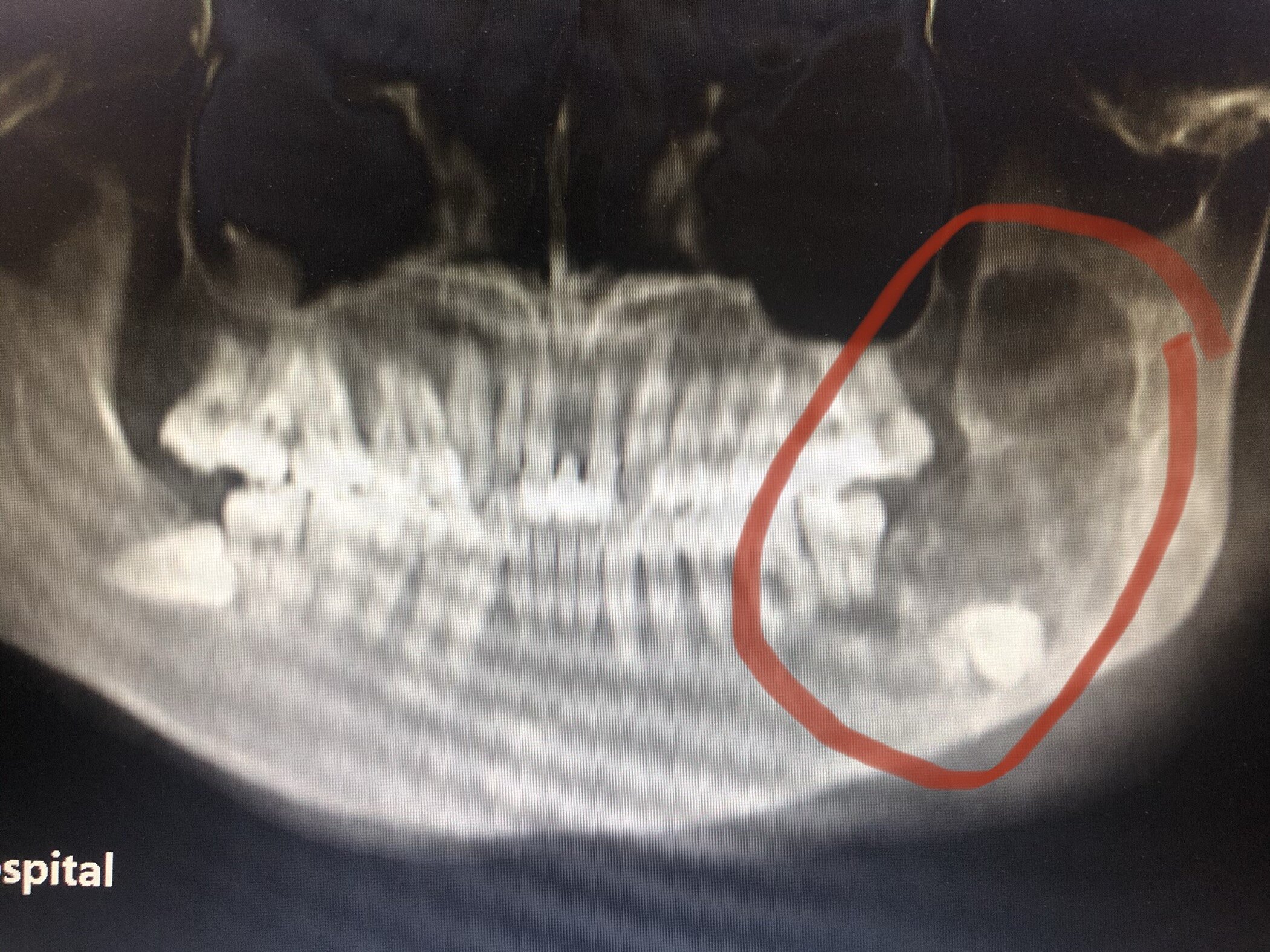牙骨质瘤x线图片图片