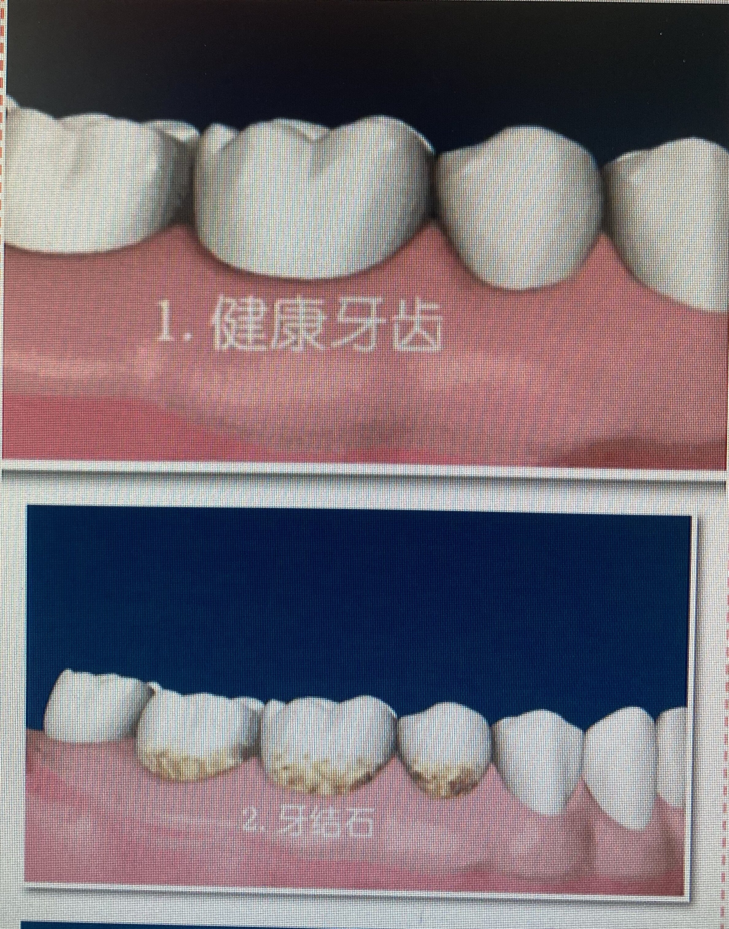 牙龈萎缩程度图片
