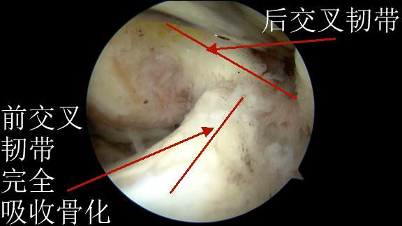 6前交叉韧带完全吸收骨化.png