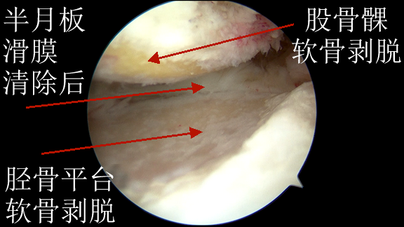 8半月板滑膜清除后.png