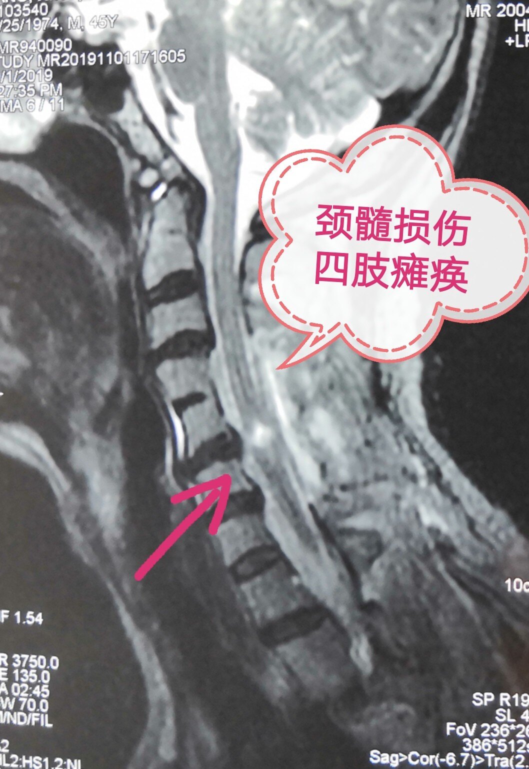 脊髓损伤_治疗方式_康复锻炼 - 好大夫在线