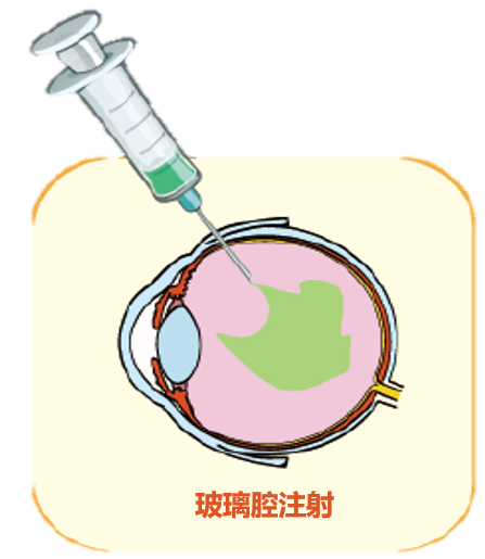 抗vegf治疗是眼内注射治疗,但不是"一针灵",最开始需要连续三个月每月