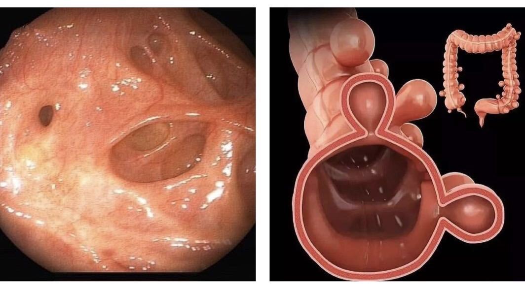 升结肠多发憩室图片图片