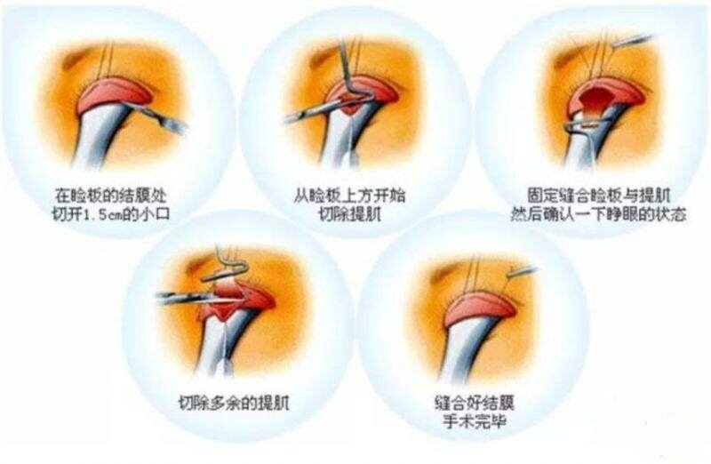 为什么割双眼皮要做上睑提肌