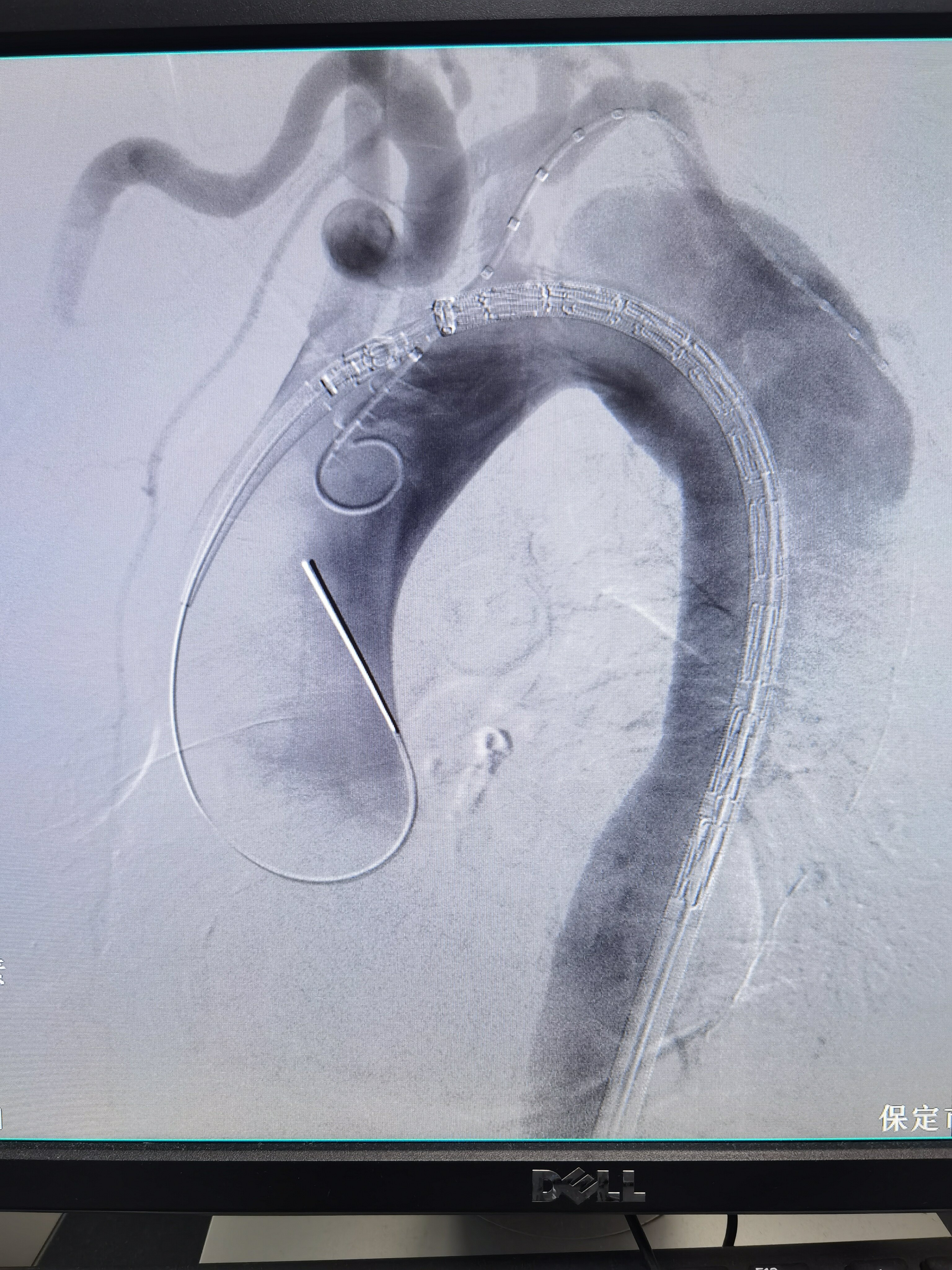 主动脉夹层动脉瘤的介入腔内治疗 - 好大夫在线