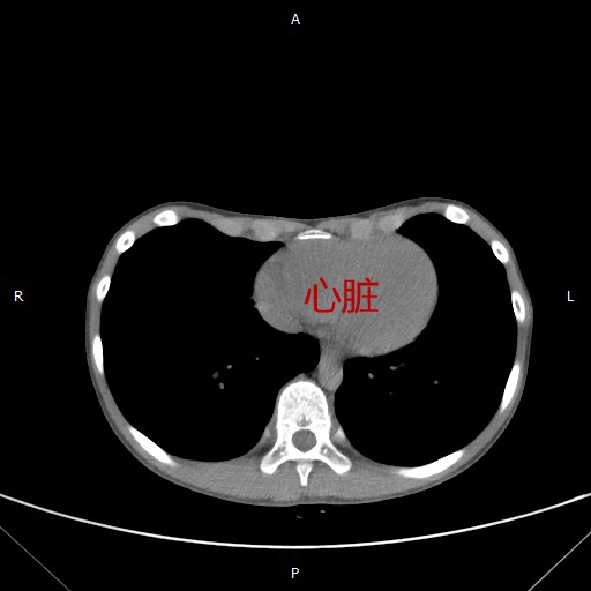 漏斗胸ct图片图片