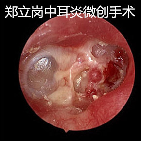 胆脂瘤中耳炎,耳内镜微创手术好处多