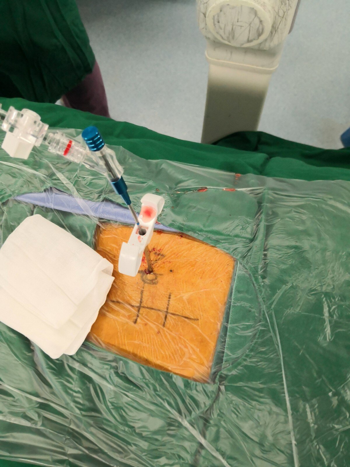 微创球囊扩张椎体成形术治疗腰椎骨质疏松性压缩骨折_骨质疏松 - 好